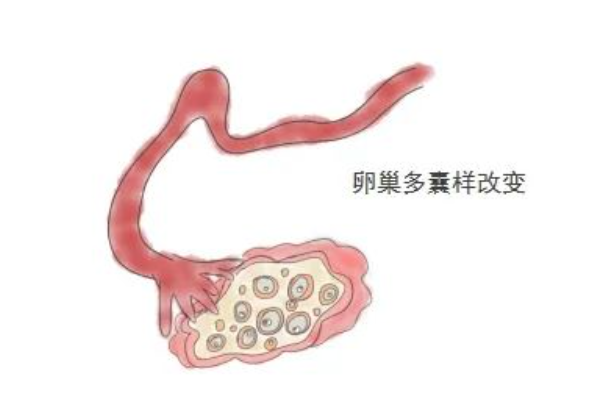 多囊卵巢人群如何选择生殖技术？分析人授和试管的技术区别