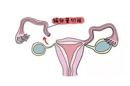 输卵管切除对身体有影响吗，做手术前需要慎重考虑
