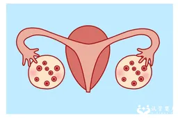 雷火灸可以治疗多囊卵巢吗，本文将分析雷火灸的作用与治疗效果