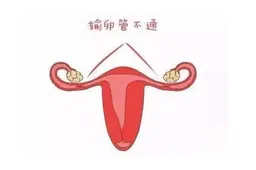 输卵管堵塞有什么症状，月经异常与腹痛都是输卵管堵塞的表现