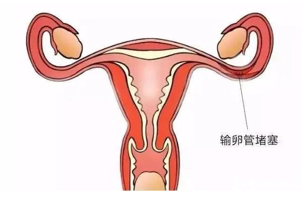 输卵管堵塞了怎么怀孕，这三种助孕方法可供选择