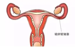 输卵管堵塞了怎么怀孕，这三种助孕方法可供选择