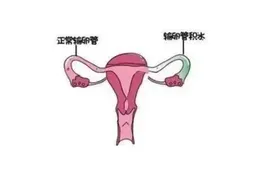 输卵管造影有什么作用，患有不孕症的姐妹一定要做