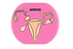 输卵管切除会影响月经吗，切除后对身体有这些负面影响