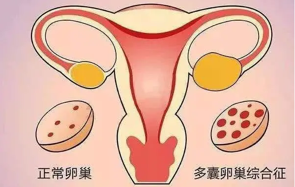 多囊促排怀孕的成功率