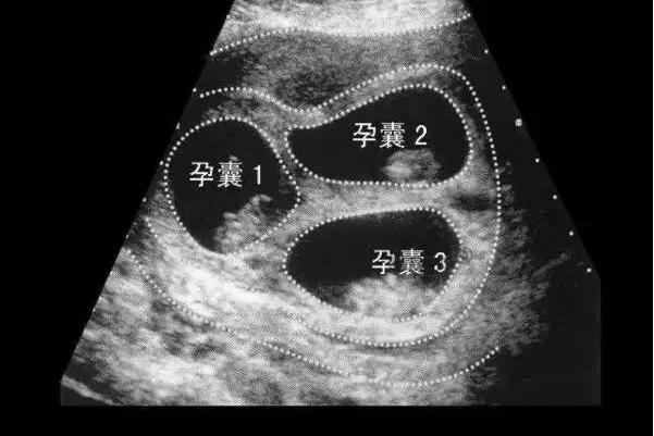 试管移植会增加多胎妊娠风险