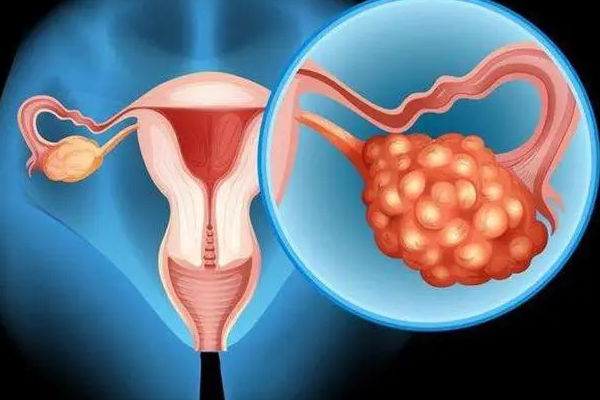 多囊女性二次试管成功