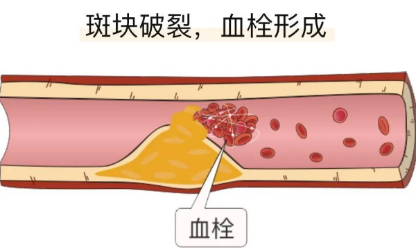 移植后血栓要多散步