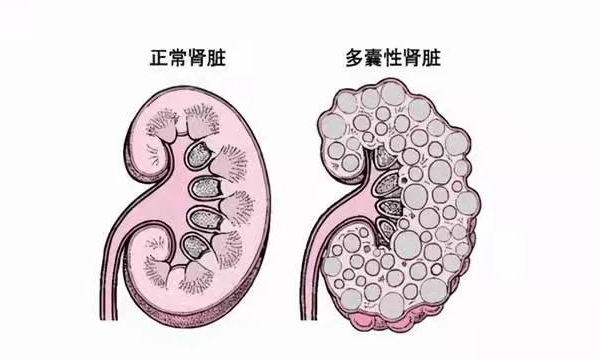 代试管能降低多囊肾