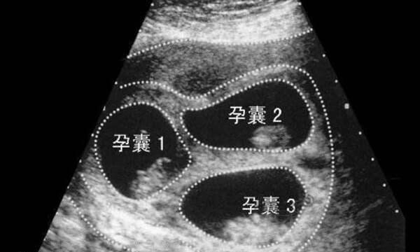 30岁三胞胎试管成功率