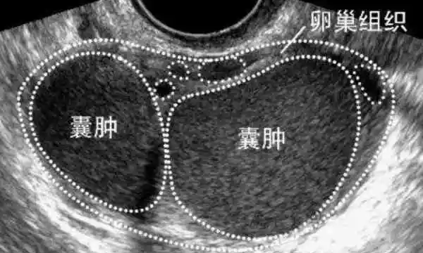 附件包块不一定是恶性