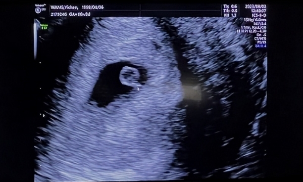 移植26天b超孕囊偏小2毫米