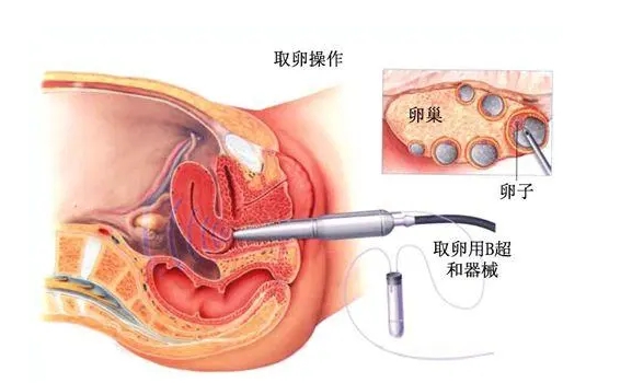 短方案不能连续两个月取卵